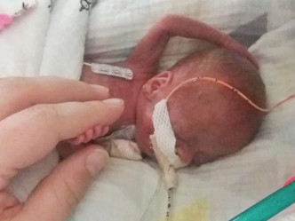 Richard早产131天，起初仅有父母一只手掌的大小。网图