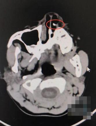 經電腦掃瞄檢查後，發現鼻內的是一顆牙。 網圖