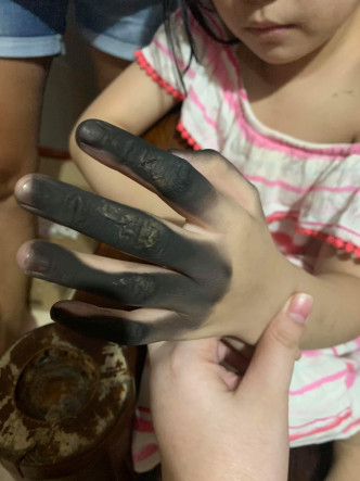 女童4指被燒黑。（網圖）