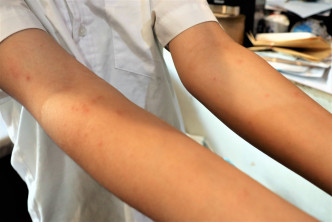 患者皮肤会出现红疹及痕痒。(活力澎湖公益平台FB图片)