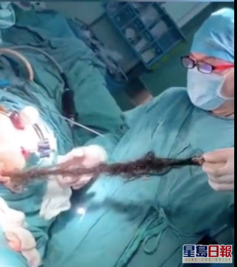 医生在畸胎瘤拉出长达两米多的毛发。网图