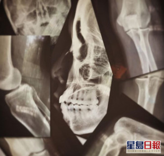 廖碧兒受傷後照的X光片。