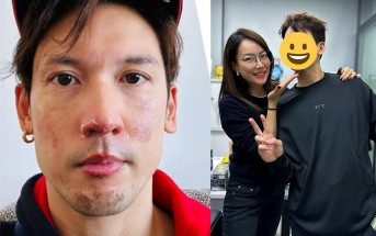42歲關智斌臉部二級燒傷後重返靚仔行列 霍汶希親自驗證：仲係好嫩滑