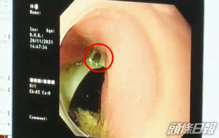 醫生在胃鏡發現牙刷（紅圈示）的蹤影。互聯網圖片