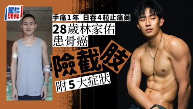 癌症|手痛1年狂吞止痛藥揭患骨癌 28歲男星林家佑險截肢 癌症|手痛1年狂吞止痛藥揭患骨癌 28歲男星林家佑險截肢