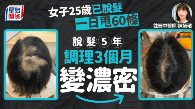 產後脫髮｜脫髮5年！港女25歲起日掉60條頭髮 中醫調理3個月變濃密