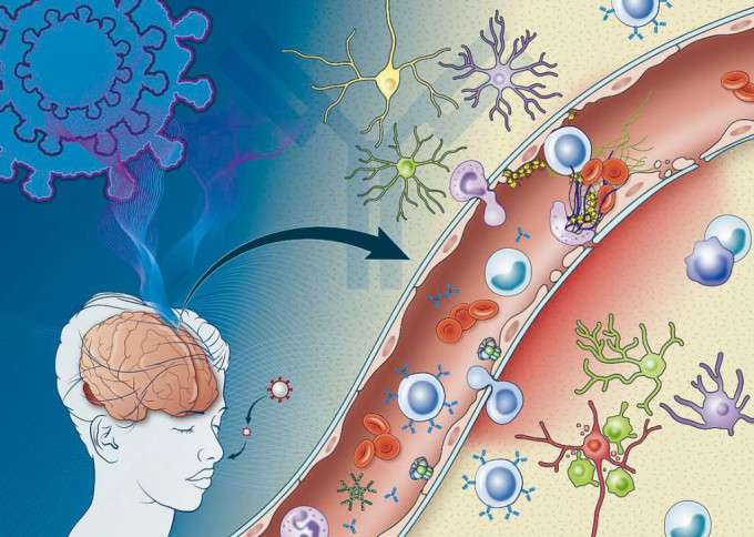 研究指新冠病毒感染引發的免疫反應，會傷害大腦血管。