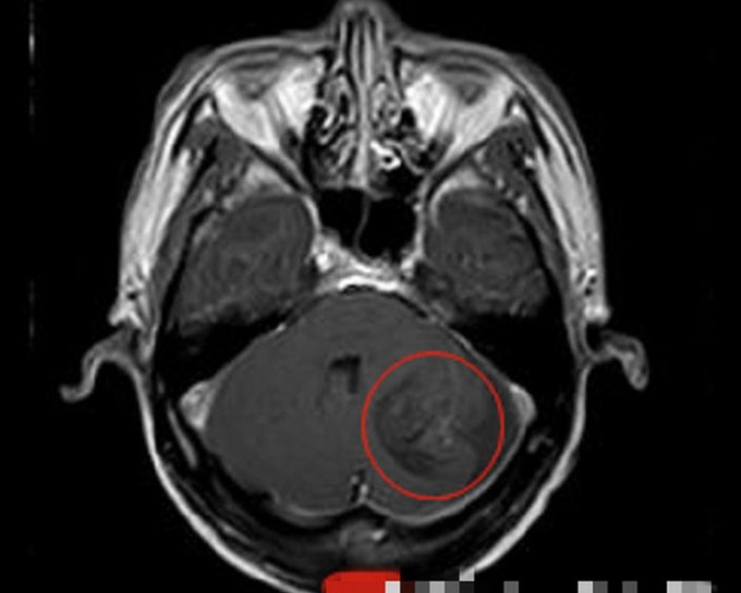 醫生診斷出男子患上腦囊蟲病。網圖