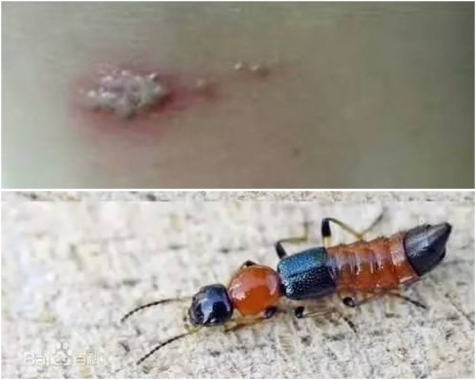 隐翅虫被拍死会释放出毒液令皮肤出红斑及脓疱。