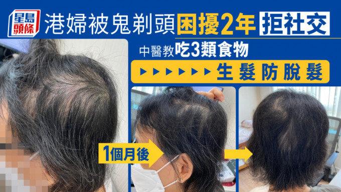 港婦被鬼剃頭困擾2年不願社交，中醫教吃3類食物生髮防脫髮。