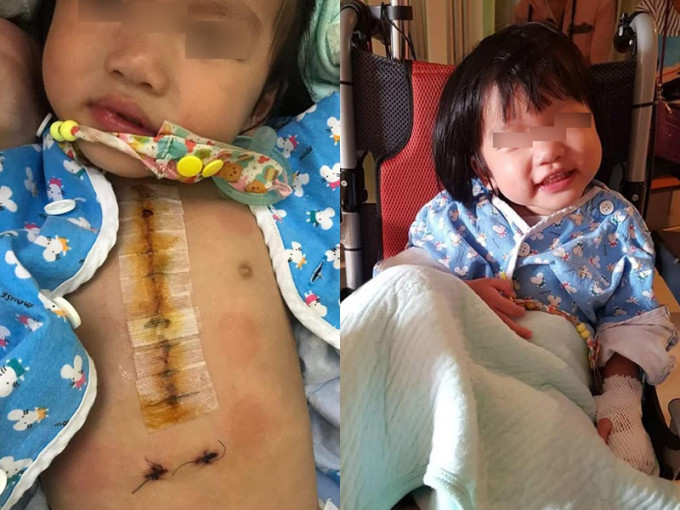 2岁女儿已经做过2次大手术。网图