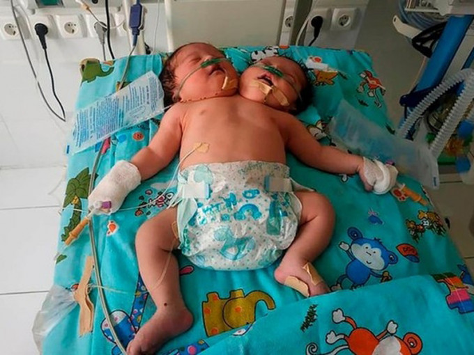 烏茲別克孕婦在21週產檢獲告知懷有畸胎，但被老爺禁止流產，結果誕下「雙頭嬰」。(網圖)