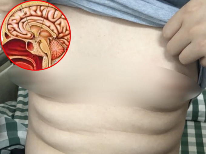 25歲男子胸部腫脹飆乳汁，竟因腦部垂體長瘤。(網圖)