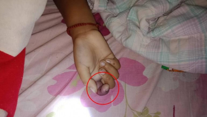 女童手指有類似被蛇咬過的瘀傷。（互聯網圖片）