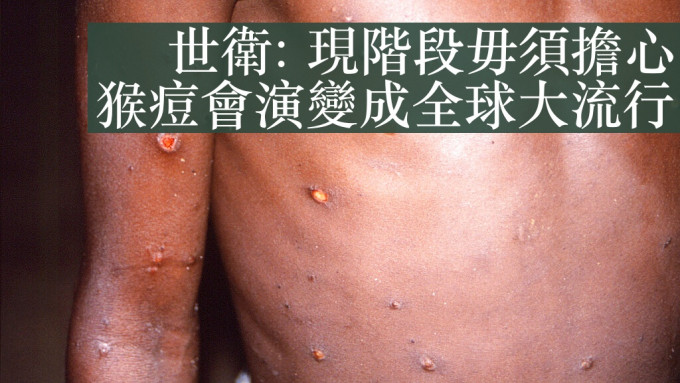 世衛指非洲以外其他國家及地區，發現愈來愈多猴痘確診和疑似個案，但現階段毋須擔心會演變成全球大流行。AP圖片