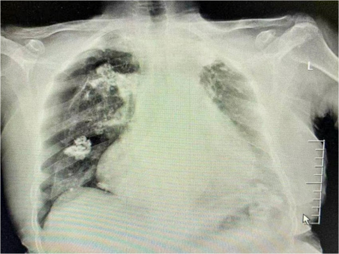 江苏妇在针灸时竟被扎穿肺，右肺被压缩了一半。网图