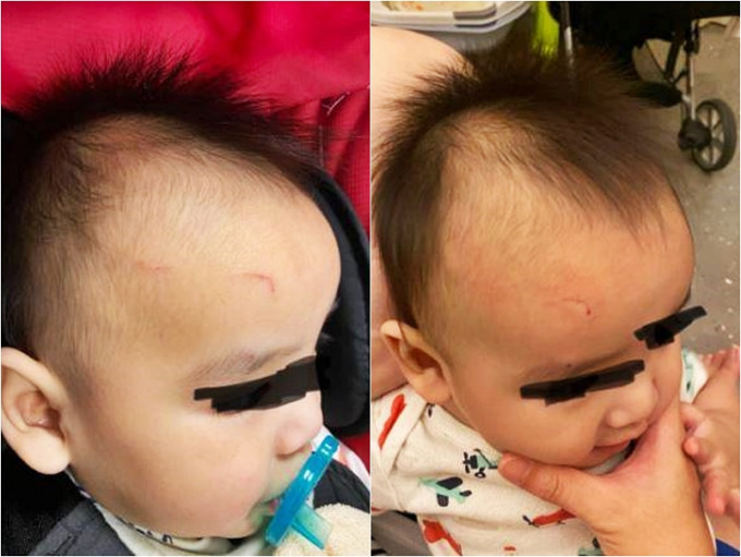 8月大的嬰兒臉部被床架鐵件割傷。Facebook專頁「爆料公社」圖片