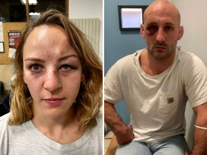 法国金牌柔道女选手自爆遭男友家暴，互相发布受伤照片。网图