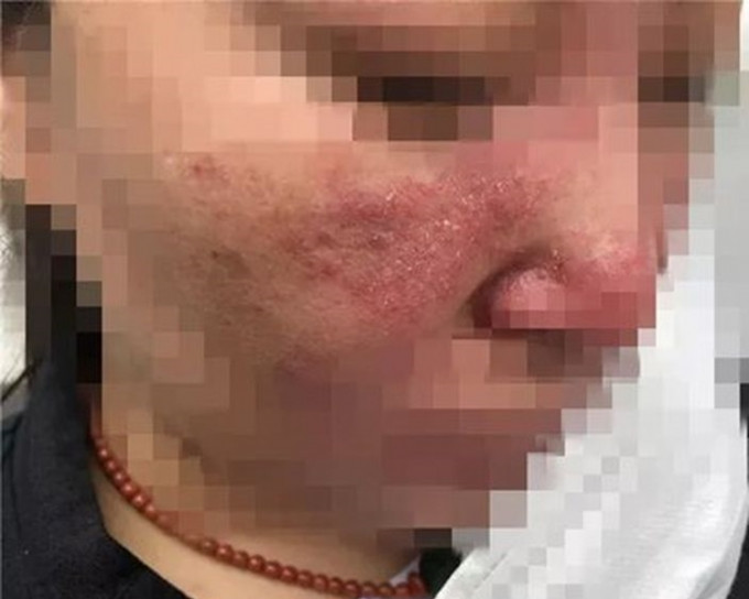张女士被诊断为「皮肤炎」。网图