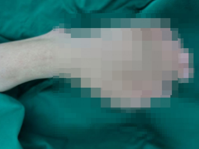 廣東潮汕一名21歲男子左腳從出生起就患有「多趾畸形」，一腳竟有9隻腳趾。 網圖