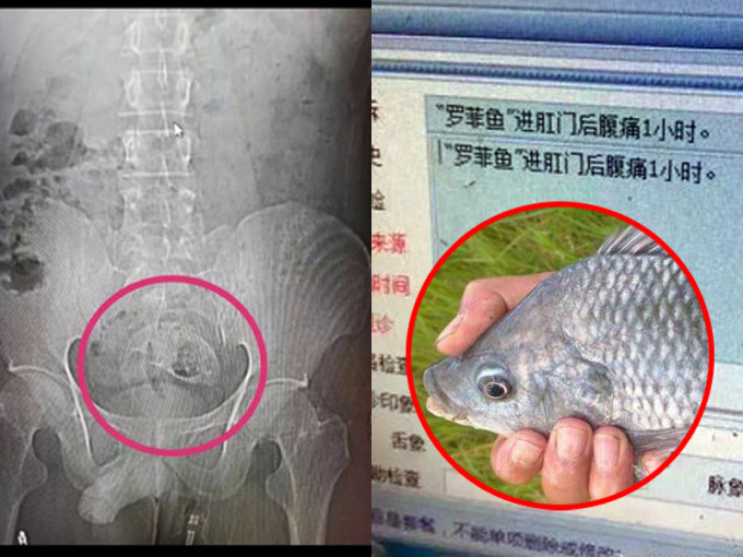 男子肚痛就診，肛門內發現整條鯽魚，稱不小心坐到魚上。(網圖)