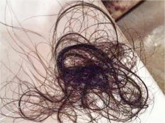 杭州一名女童每逢压力大就会吃头发。网图