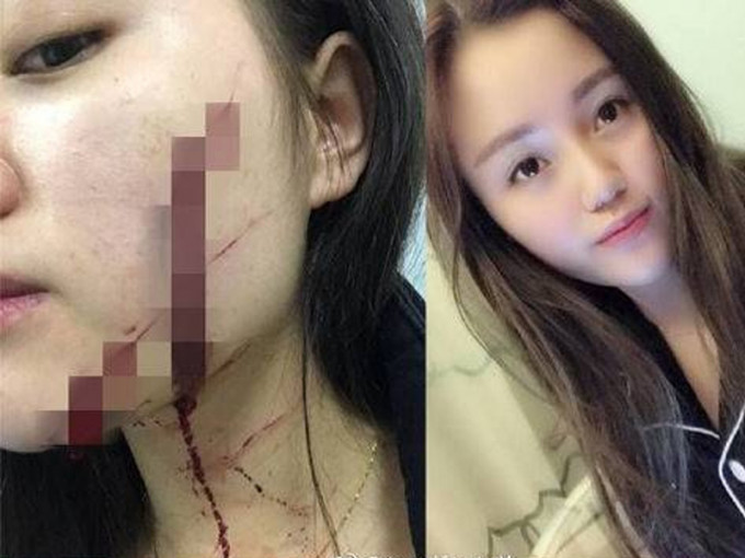 劉雪琪事發後左臉留有一道觸目驚心的刀傷。（網圖）