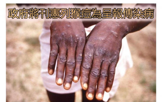 因应猴痘来势汹汹，政府下周刊宪将猴痘列为法定呈报传染病。资料图片