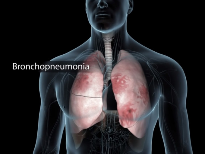 肺炎会令到呼吸困难、胸痛、咳嗽、发烧或发冷等。影片截图