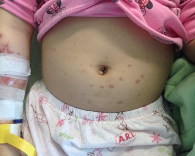 女童患上過敏性紫斑症。 網上圖片