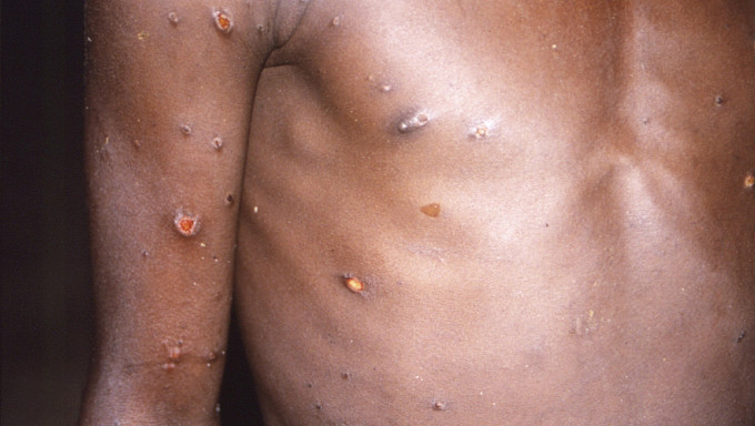 印度及沙特现首宗猴痘，世衞下周四再开会评估。AP图