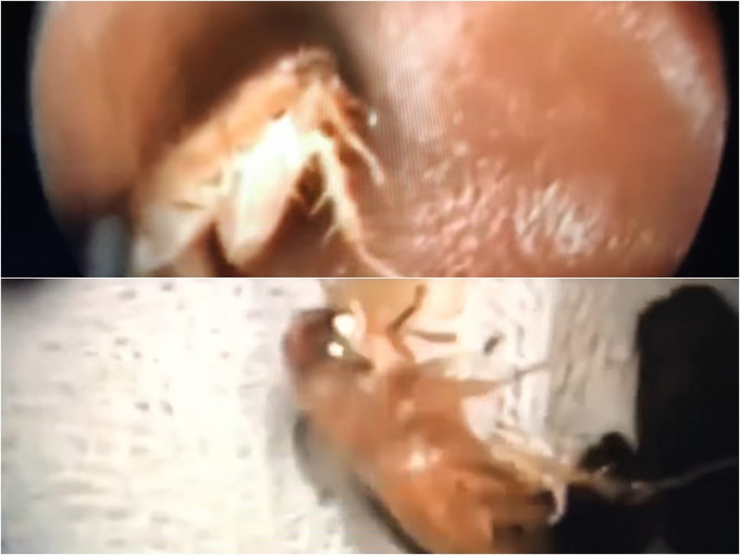 鼻喉科醫生從耳窩取出曱甴的過程。來講兒科急診的543-吳昌騰醫師FB影片截圖