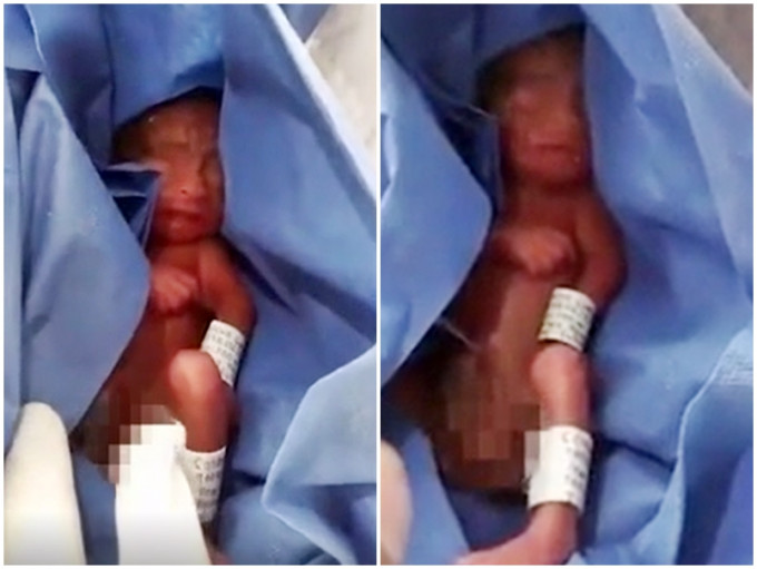 墨西哥醫院誤判23周早產嬰死亡，他躺在冰櫃6個小時後「奇蹟生還」。網圖