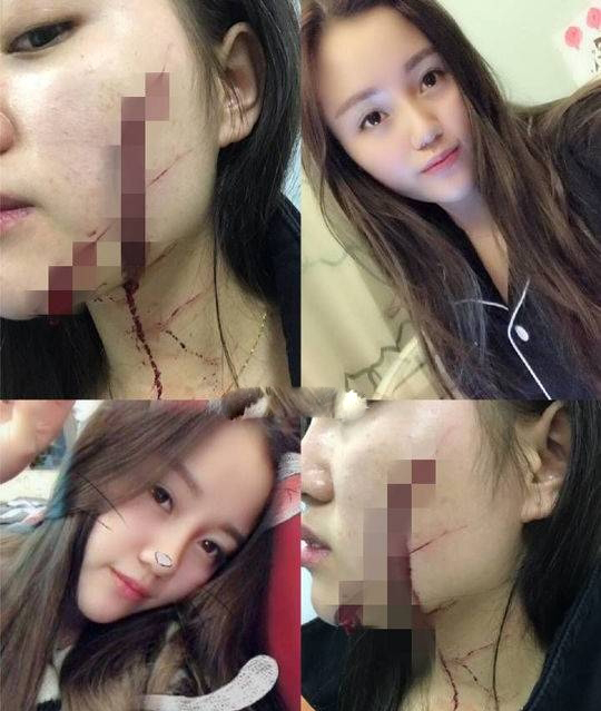 劉雪琪在微博發布自己受傷時拍的照片。（網圖）