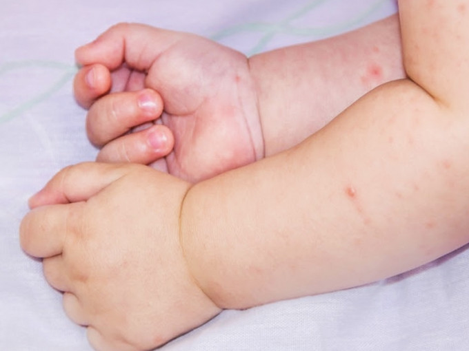 小儿湿疹又称异位性皮炎，主要成因分为内在及环境。