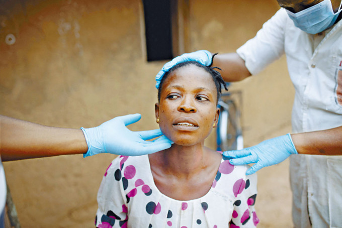 剛果民主共和國一名猴痘患者。