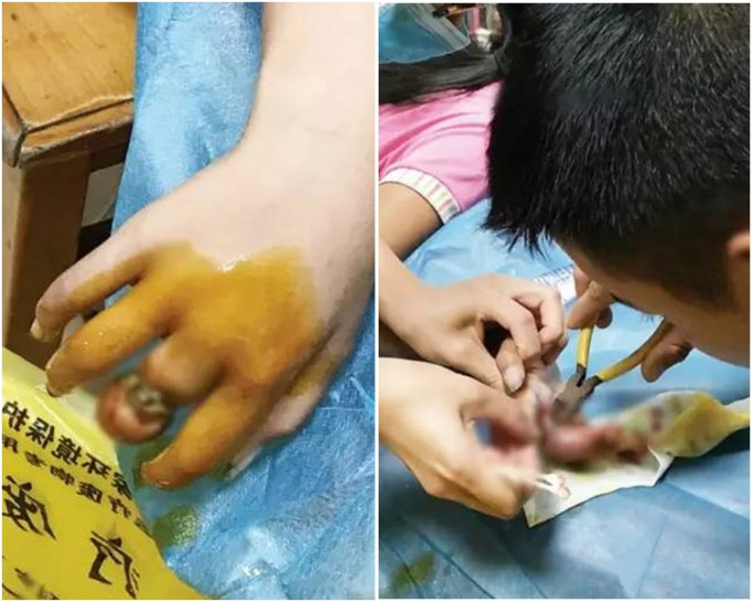 11岁女孩被戒指卡手近3个月，手指腐烂露骨。网图