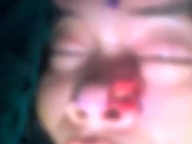 劉男被發酒瘋同學咬甩鼻，左邊鼻翼被咬掉。 網上圖片