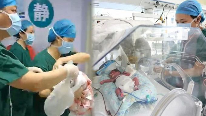 山东24岁产妇早产1女4男5胞胎，机率仅6000万分之一。