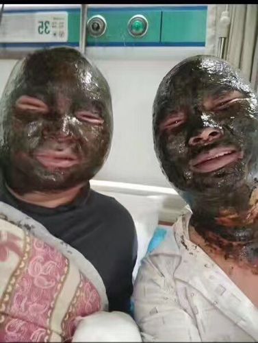 4名伤者被医护人员在脸涂上厚厚的黑色药膏，自拍相片。网图