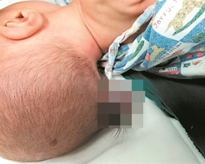 男婴后脑长出「小尾巴」。 网上图片