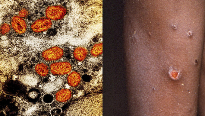 印度发现首宗猴痘死亡病例，苏丹报告首宗病例。AP资料图