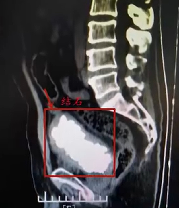 X光图可见男子手术前有严重膀胱结石问题。网上图片