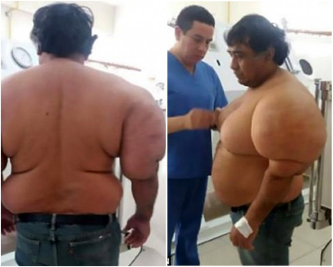 患病后的马丁体重暴增近30公斤，并出现严重高血压。网图