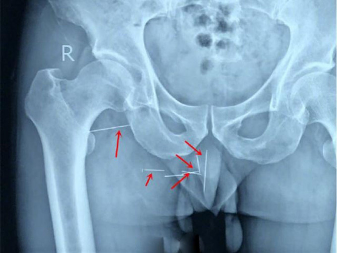 男子就醫才知道自己臀部被多根針插入體內。（網圖）