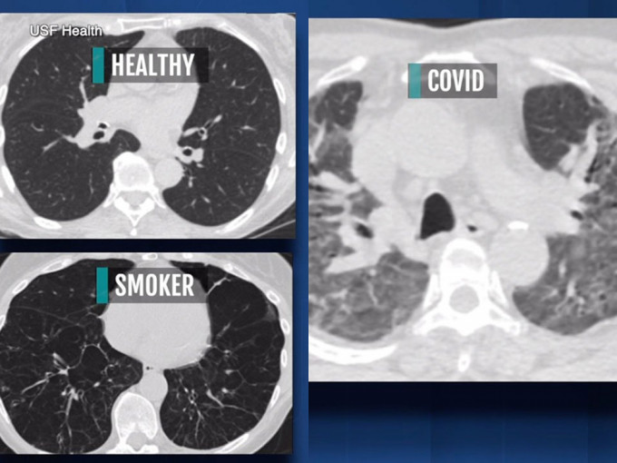 有醫生指新冠患者肺部傷疤比吸煙嚴重，包括無症狀患者。