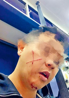 ■休班警长遇袭受伤，面颊有两条交叉伤痕。　