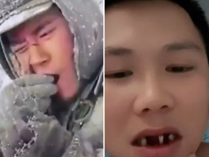 江西男子模仿《长津湖》情节(左)硬啃冷冻薯仔，结果导致3只牙齿移位，须要拔除(右)。影片截图