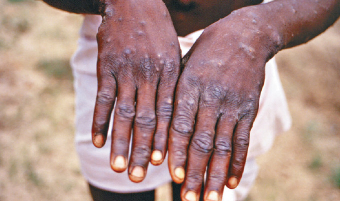 印尼出现首宗猴痘个案。AP资料图片