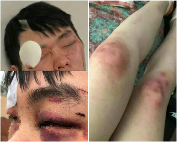 多名中国留学生被澳洲青年殴打。网图